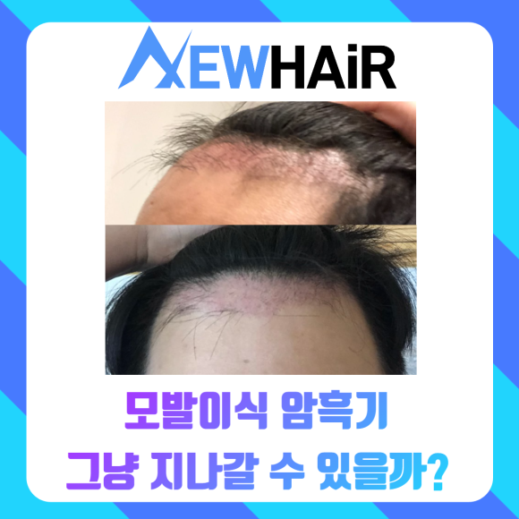 모발이식암흑기 그냥 지나갈 수 있을까? 관련 이미지 1