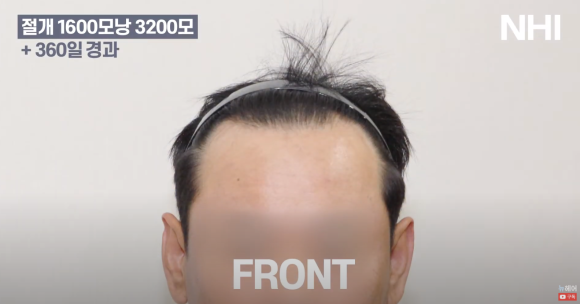 [뉴헤어] 모발이식 1600모낭 심고 1년 후 결과 l 남자 헤어라인 교정 관련 이미지 2