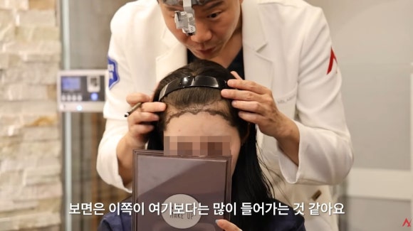 Women’s Hairline Correction: Design Points More Important Than Lowering the Forehead image 4