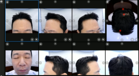 모발이식 전 꼭 확인해야 할 7가지 FAQ, 수술보다 중요한 준비 과정 관련 이미지 5
