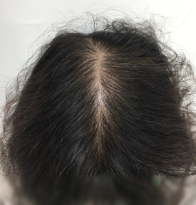 항암 탈모치료, 모발 회복에 도움이 되는 치료법은? 관련 이미지 3