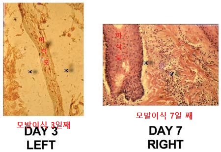모발이식 받은 사람은 꼭 알아야할 이식모 생착 과정 총정리: 어떻게 하면 더 잘자랄까? 관련 이미지 4