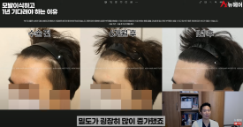 모발이식경과 1년을 기다려야 하는 이유 관련 이미지 14