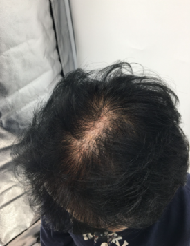 탈모모낭주사, 4달 치료받고 자신감 되찾은 50대 여성 사례 관련 이미지 7