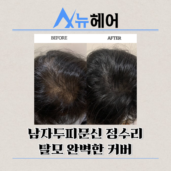 남자두피문신 정수리탈모 완벽한 커버 관련 이미지 2