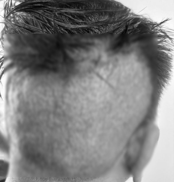 Recovery After Hair Transplant Surgery: Is It Okay to Bend Your Head Down? (Precautions by Recovery Stage) image 2