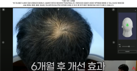 남성 정수리 탈모 치료 수술없이 주사만으로?(탈모약+주사치료) 관련 이미지 3