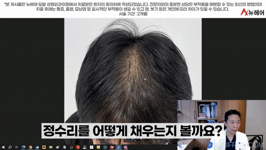 머리숱이 많아보이는 두피문신! 실제사례후기로 보는 비포&애프터 관련 이미지 6