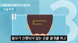 A Complete Guide to Non-Incisional Hair Transplant Methods image 5