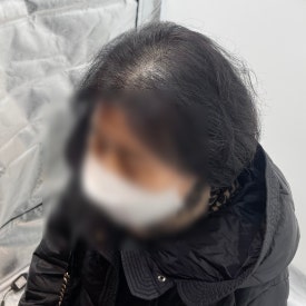 여성두피문신? 60대 실제 사례 사진으로 확인하세요 관련 이미지 14