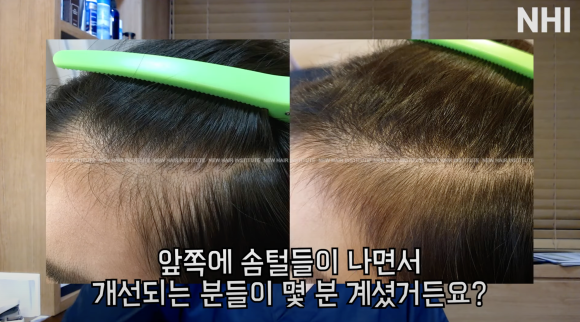 엠자탈모 / 정수리탈모 / 여성탈모 각각 탈모치료법 소개, 탈모약 효과 관련 이미지 1