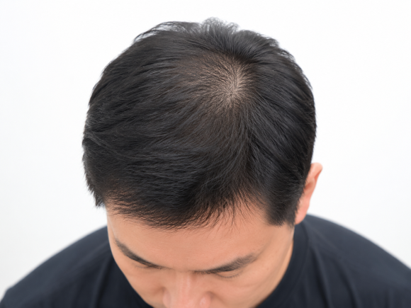 모발이식 절개&middot;비절개보다 중요한 것은? 결과를 좌우하는 5가지 관련 이미지 6