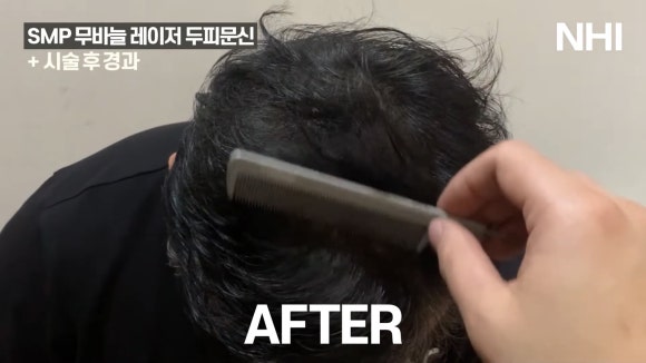 두피문신 전후사진 ㅣ뉴헤어 ㅣ 강남두피문신 관련 이미지 4