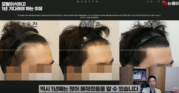 모발이식경과 1년을 기다려야 하는 이유 관련 이미지 16