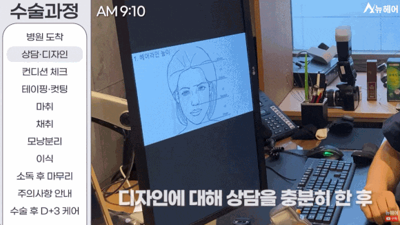 모발이식과정? A~Z 전부 공개합니다(동영상 포함) 관련 이미지 1
