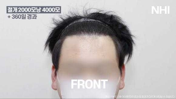 M자탈모(엠자탈모) 모발이식 1년 후 모습 공개 l 2000모낭(4000모) 관련 이미지 3