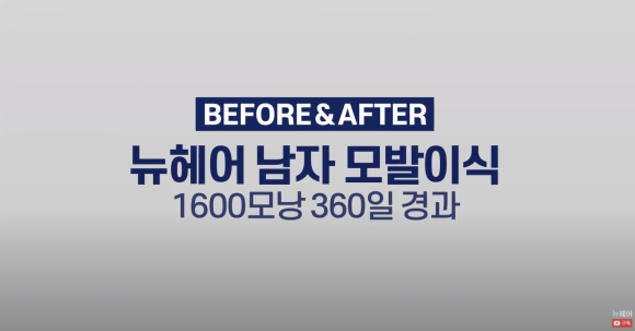 [뉴헤어] 남성 탈모 모발이식 1년 후 사진 공개합니다 관련 이미지 1