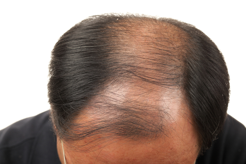 앞머리 탈모와 정수리 탈모 각각의 치료방법 관련 이미지 1