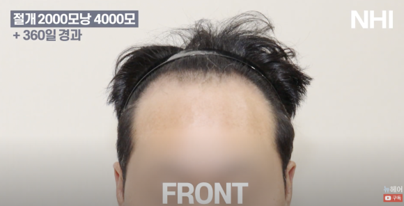 [뉴헤어] 남자 모발이식 2000모낭(4000모) 전후 비교 l 엠자이마 l 탈모 관련 이미지 2