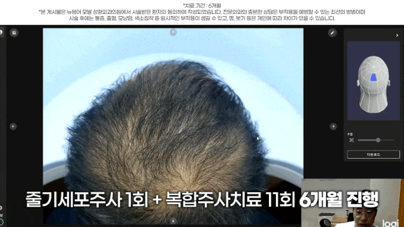 남성 정수리 탈모 치료 수술없이 주사만으로?(탈모약+주사치료) 관련 이미지 5