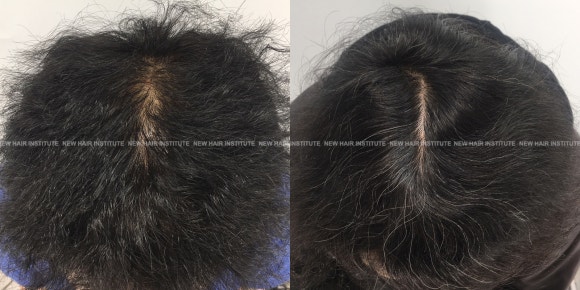 남성형 탈모 치료, 6개월 만에 이루어낸 변화 대공개 관련 이미지 11