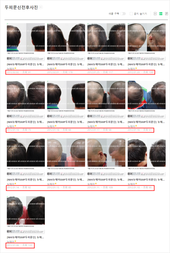 두피문신 병원? 전문의가 알려주는 방문 전 확인사항 3가지 - 1편 관련 이미지 3