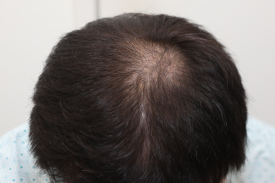 How Should You Start a Hair Loss Management Plan at First? image 2