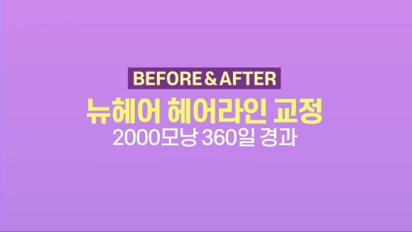 헤어라인교정(여자 모발이식)으로 넓은 이마 축소하기 관련 이미지 1