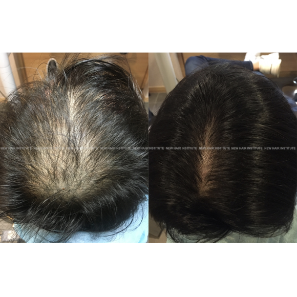 정수리 탈모 치료 방법 #모낭주사 #탈모주사 2년 후기 l 모발이식 후에 탈모 관리 관련 이미지 1