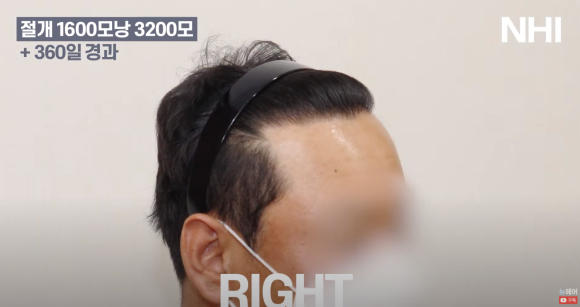 [뉴헤어] 모발이식 1600모낭 심고 1년 후 결과 l 남자 헤어라인 교정 관련 이미지 5