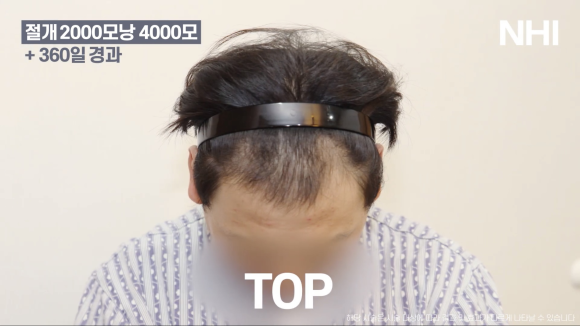M자탈모(엠자탈모) 모발이식 1년 후 모습 공개 l 2000모낭(4000모) 관련 이미지 6