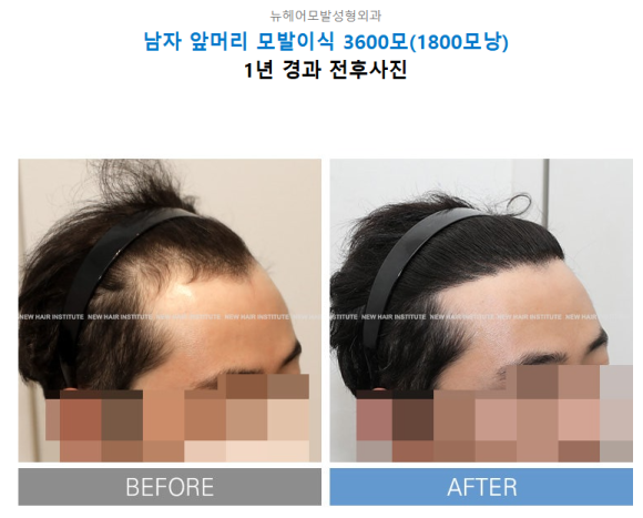 모발이식이 꼭 필요한 사람 VS 필요 없는 사람, 탈모 유형별 확인법 관련 이미지 3