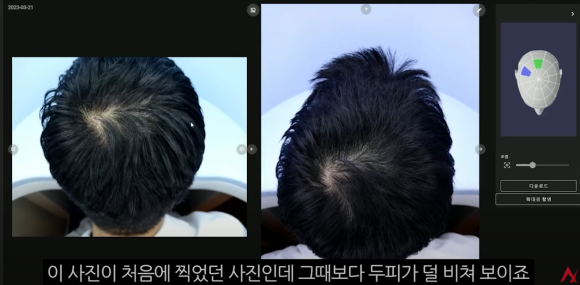 What Can Hair Loss Testing Tell Me About My Hair Loss Treatment? image 2