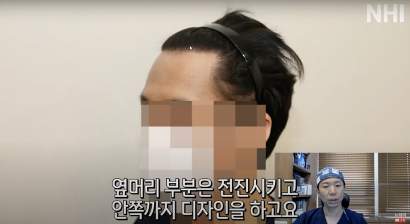 엠자탈모 모발이식 1년 후l 모발이식 후기 #높은이마 #고밀도이식 설명해드립니다 관련 이미지 5