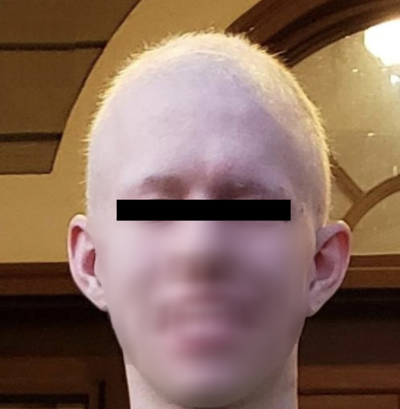 두필루맙, 원형 탈모 치료 사례 보고 관련 이미지 4