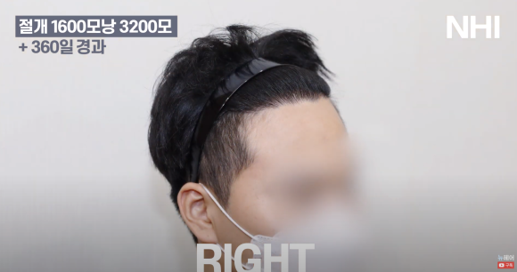 남자 모발이식 1600모낭 1년 지난 후 사진 경과 후기 관련 이미지 5