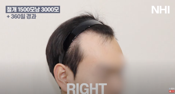 [뉴헤어] 모발이식 1500모낭 1년 후 사진 공개 l M자 엠자 남성탈모 관련 이미지 3