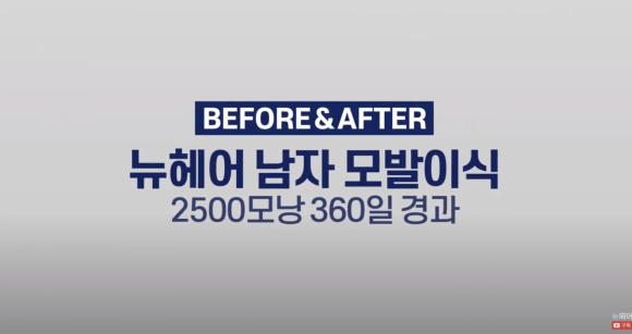 넓은 이마 모발이식 l 탈모 모발이식 후기 사진 관련 이미지 1