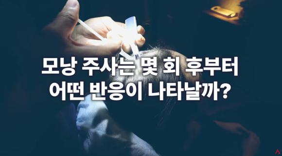 탈모 모낭주사 효과 진짜 있나요? (종류&middot;부작용) 관련 이미지 7