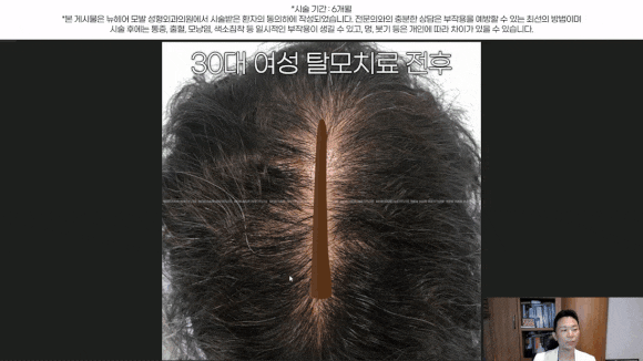 여자정수리탈모, 약 없이 치료하는 법 관련 이미지 2