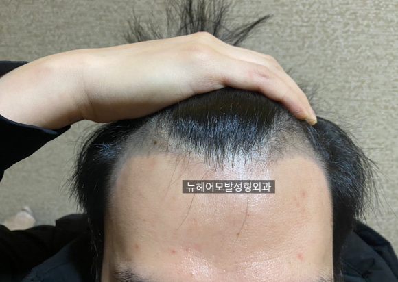 M자탈모 극복, 모발이식 VS 두피문신 더 좋은 방법은? 관련 이미지 1
