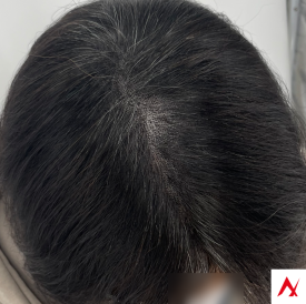 50대 여성 두피 문신(SMP)을 통한 정수리 탈모 치료 관련 이미지 7