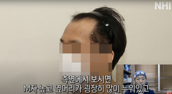 엠자탈모 모발이식 1년 후l 모발이식 후기 #높은이마 #고밀도이식 설명해드립니다 관련 이미지 4