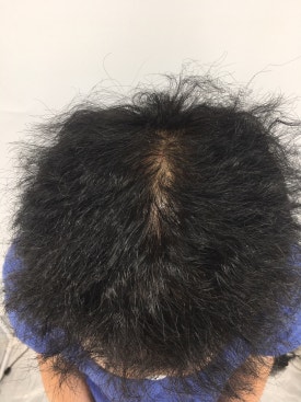 남성형 탈모 치료, 6개월 만에 이루어낸 변화 대공개 관련 이미지 3