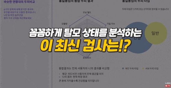 서울탈모병원? 방문 전 2가지만 확인해 보세요 관련 이미지 3