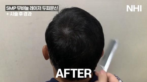 두피문신 전후사진 ㅣ뉴헤어 ㅣ 강남두피문신 관련 이미지 3