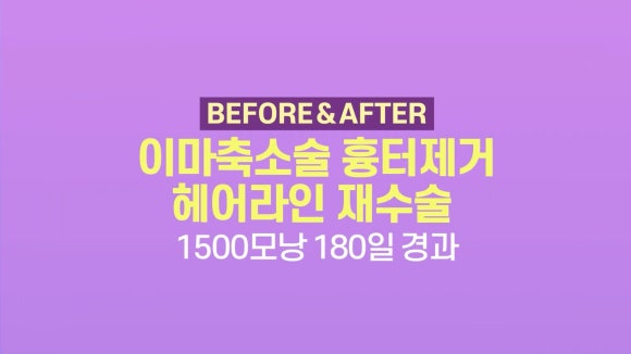 이마축소술 흉터제거 헤어라인 재수술 l 여성 모발이식 관련 이미지 1