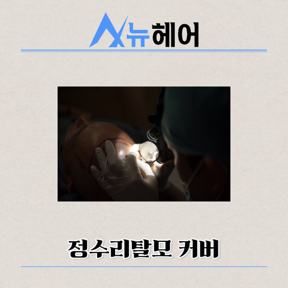 남자두피문신 정수리탈모 완벽한 커버 관련 이미지 3