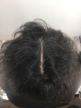 남성형 탈모 치료, 6개월 만에 이루어낸 변화 대공개 관련 이미지 8