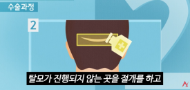 모발이식 절개&middot;비절개보다 중요한 것은? 결과를 좌우하는 5가지 관련 이미지 1
